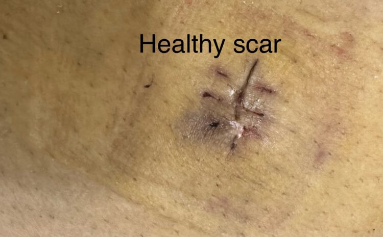  Pregnant patient with Sebaceous cyst on Abdomen